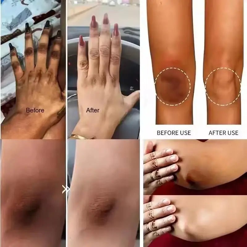 Whitening Cream Private Parts Underarm Bleaching Serum Whiten Butt Knee Brighten Inner Thigh Intimate Parts Dark Remove Melanin - JromoCompany